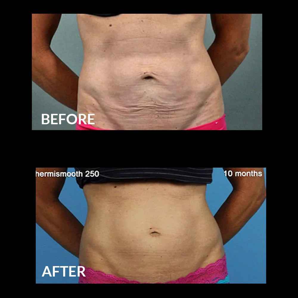 Mariposa Aesthetics & Laser Center THERMIsmooth® BODY Skin Tightening Treatments