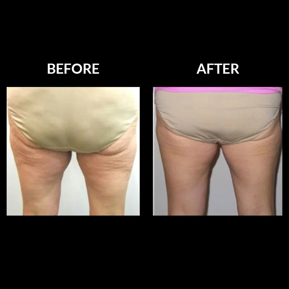 Mariposa Aesthetics & Laser Center THERMIsmooth® BODY Skin Tightening Treatments