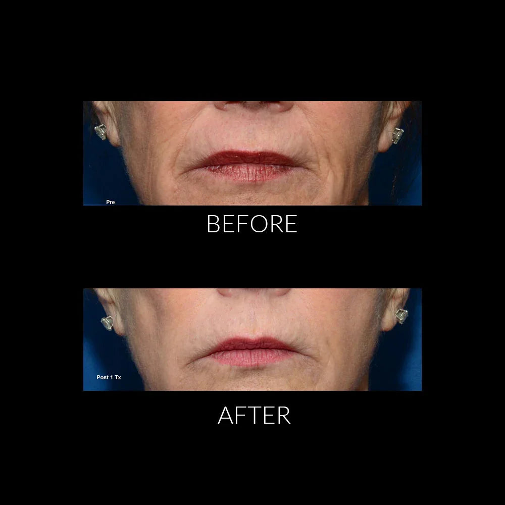 Mariposa Aesthetics & Laser Center THERMIsmooth® Face Treatments for Skin Tightening