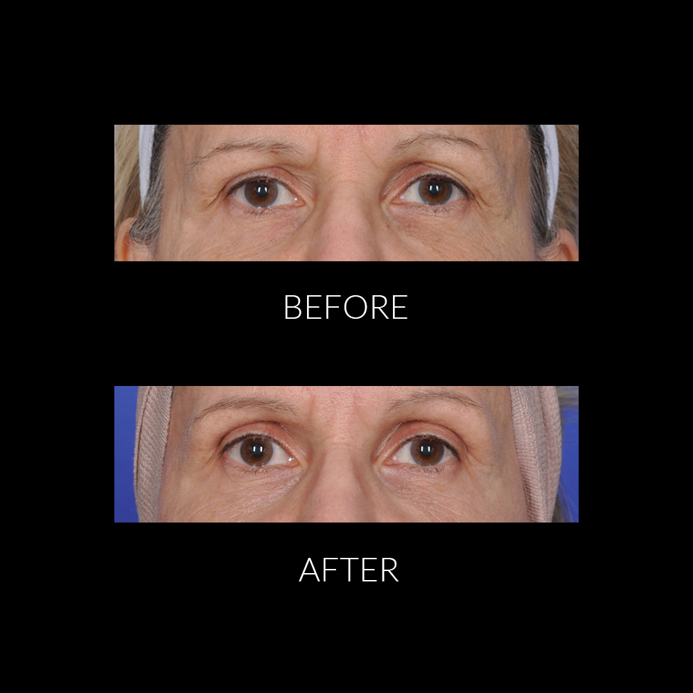 Mariposa Aesthetics & Laser Center THERMIsmooth® Face Treatments for Skin Tightening