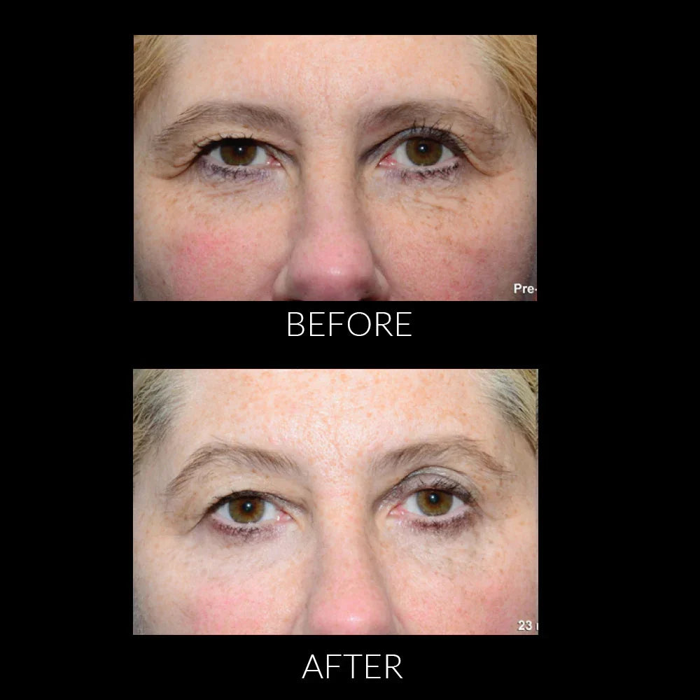 Mariposa Aesthetics & Laser Center THERMIsmooth® Face Treatments for Skin Tightening