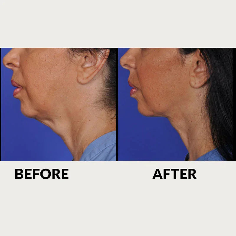 Mariposa Aesthetics & Laser Center Effective RF Skin Tightening by THERMItight®