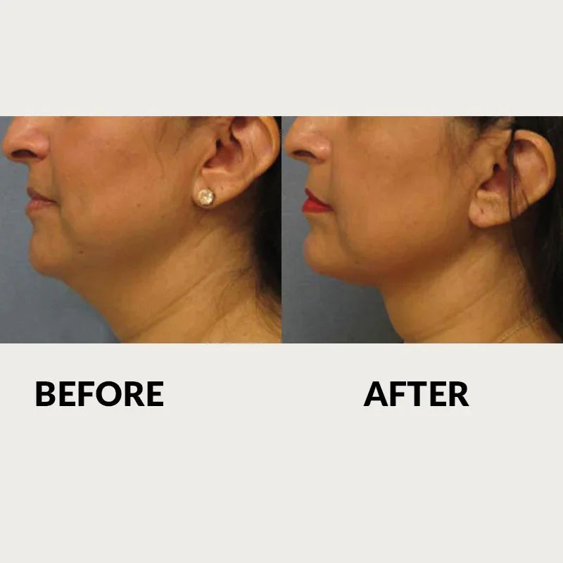 Mariposa Aesthetics & Laser Center Effective RF Skin Tightening by THERMItight®