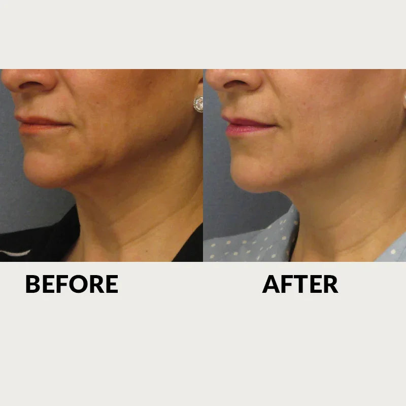 Mariposa Aesthetics & Laser Center Effective RF Skin Tightening by THERMItight®