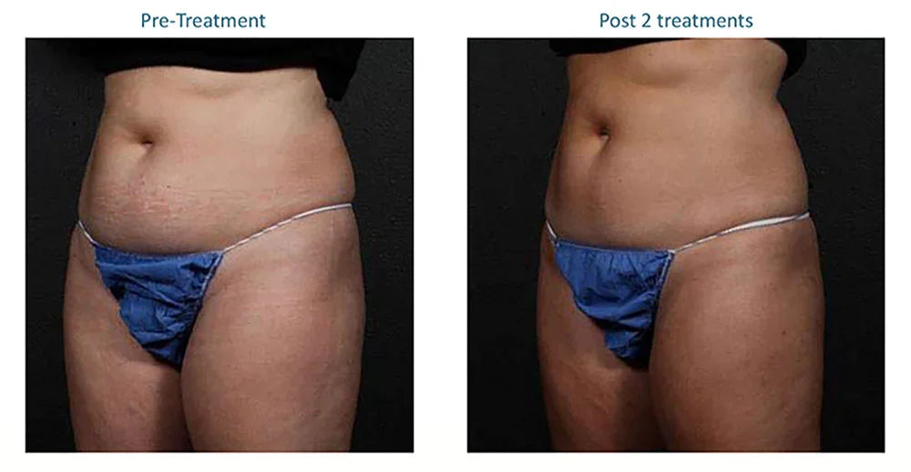Mariposa Aesthetics & Laser Center truSculpt iD: Effective Body Contouring Solution