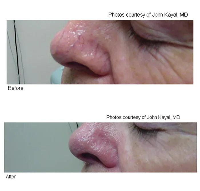 Mariposa Aesthetics & Laser Center Laser Vein Therapy Solutions