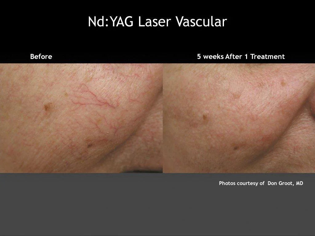 Mariposa Aesthetics & Laser Center Laser Vein Therapy Solutions