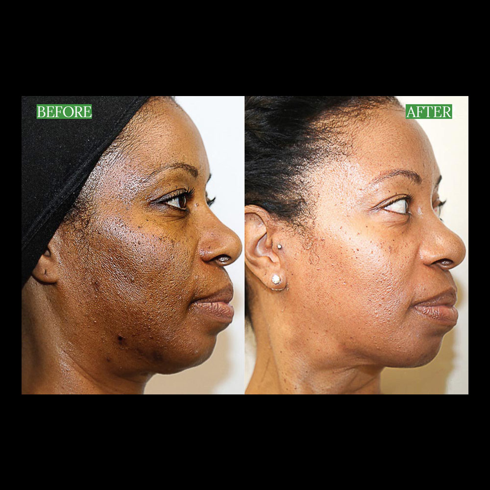 Mariposa Aesthetics & Laser Center Discover the Benefits of VI Peel Precision Plus