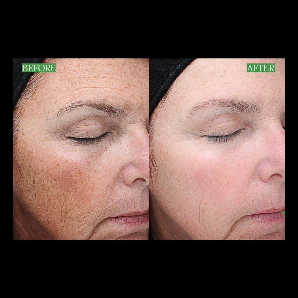 Mariposa Aesthetics & Laser Center Discover the Benefits of VI Peel Precision Plus