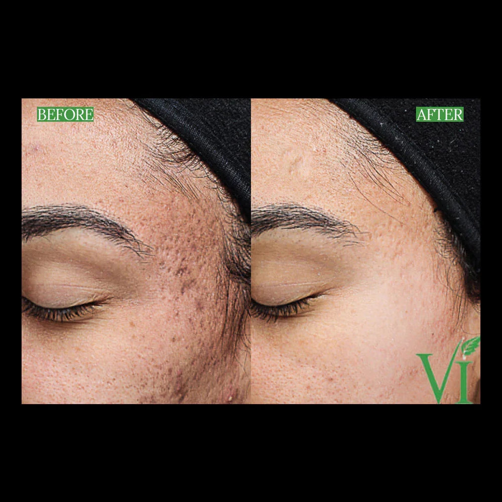 Mariposa Aesthetics & Laser Center Discover the Benefits of VI Peel Precision Plus
