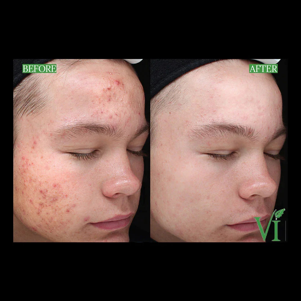 Mariposa Aesthetics & Laser Center VI Peel PURIFY - Effective Acne Treatment Solution