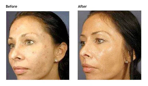 Mariposa Aesthetics & Laser Center VI Peel PURIFY - Effective Acne Treatment Solution