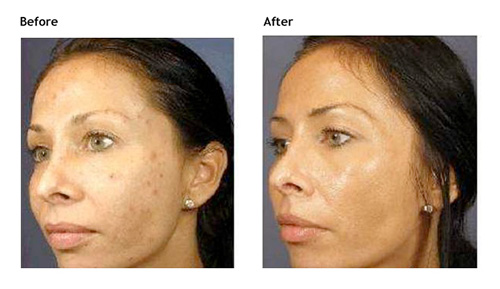 Mariposa Aesthetics & Laser Center VI Peel PURIFY - Effective Acne Treatment Solution