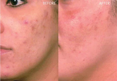Mariposa Aesthetics & Laser Center VI Peel PURIFY - Effective Acne Treatment Solution