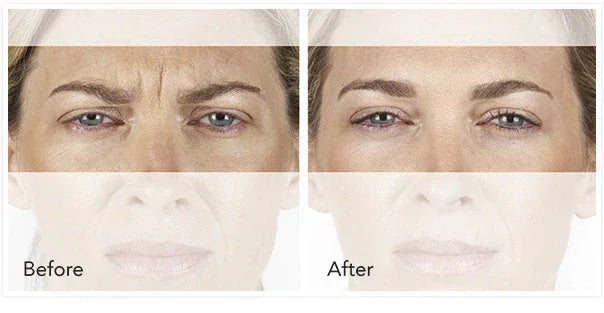 Mariposa Aesthetics & Laser Center Xeomin Neurotoxin Wrinkle Treatment