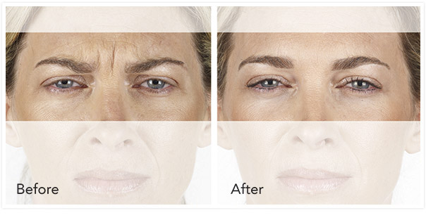 Mariposa Aesthetics & Laser Center Xeomin Neurotoxin Wrinkle Treatment
