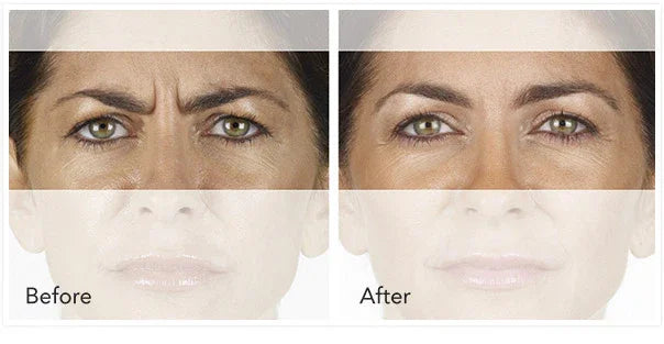 Mariposa Aesthetics & Laser Center Xeomin Neurotoxin Wrinkle Treatment